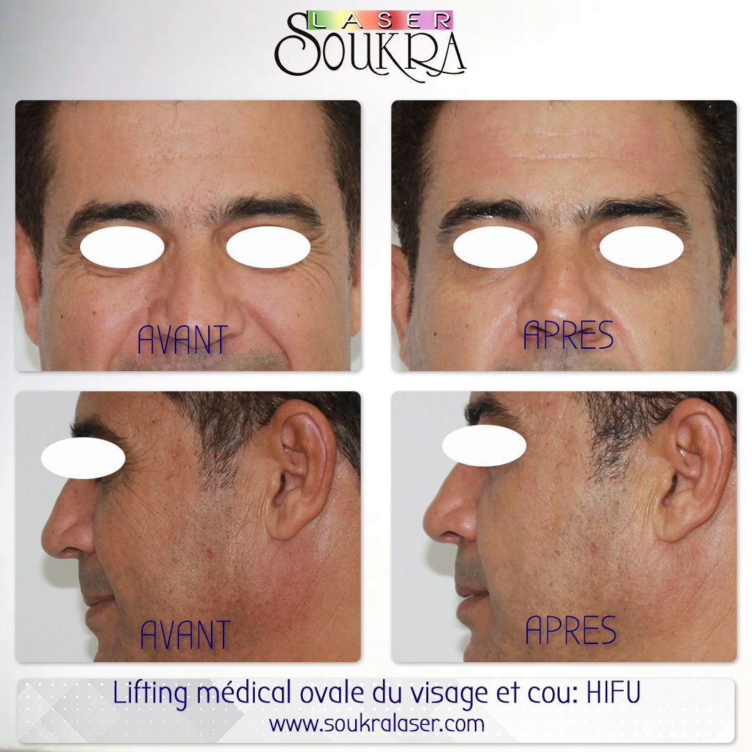 Lifting médical du visage