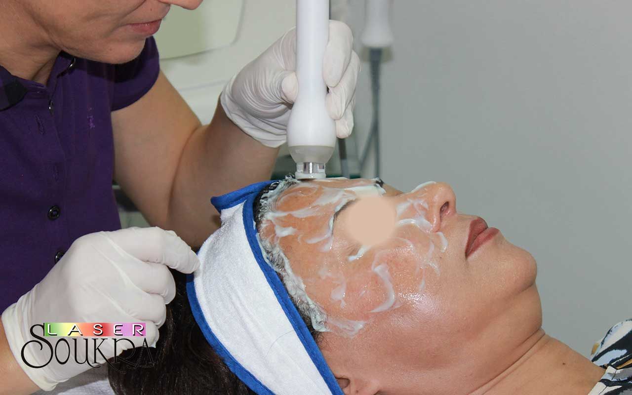 Radiofréquence au centre Soukra Laser