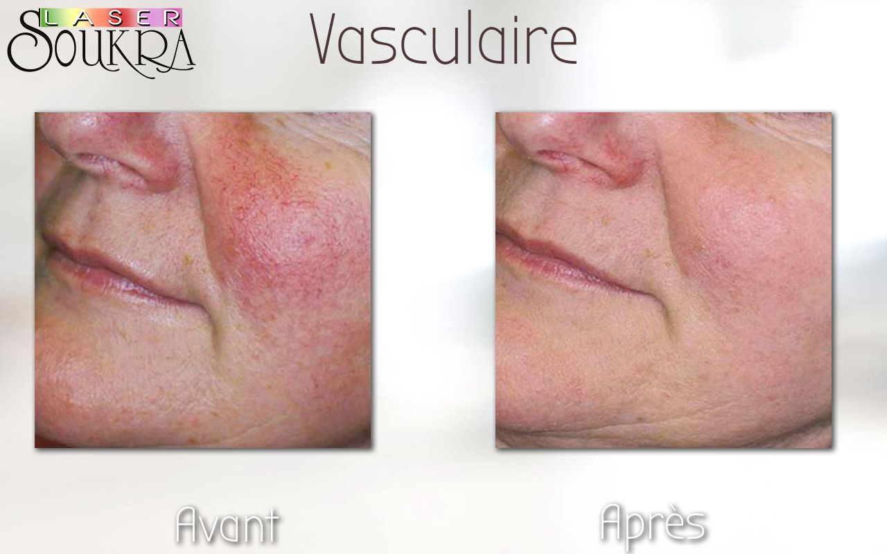 Lésions vasculaires