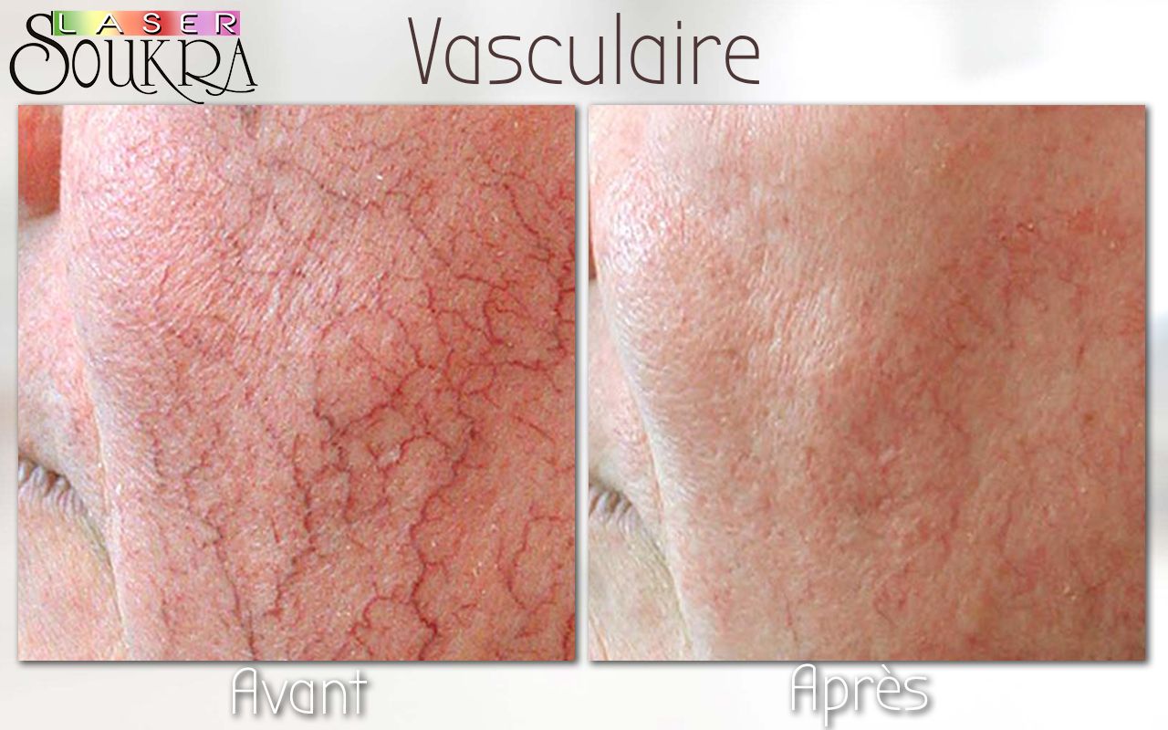 Lésions vasculaires