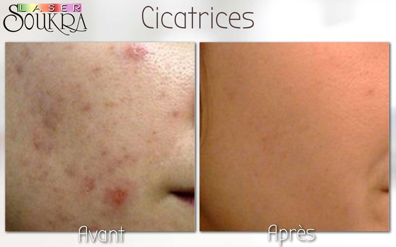 Cicatrice d’acnés 