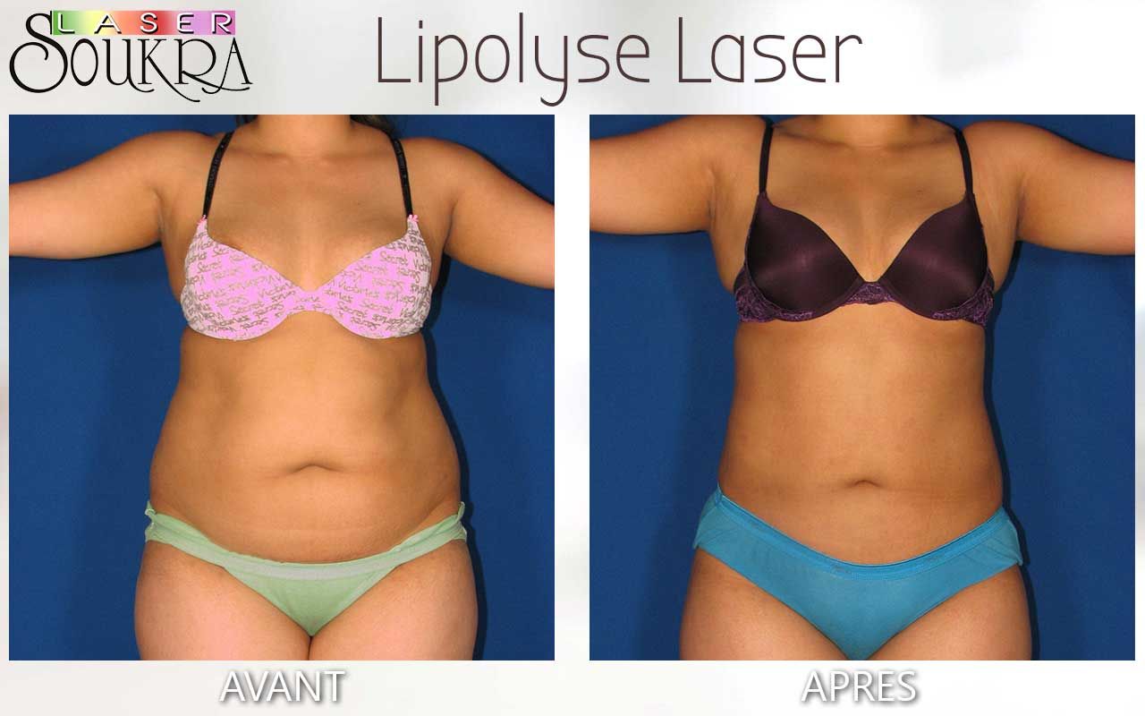 Lipolyse du ventre et des hanches