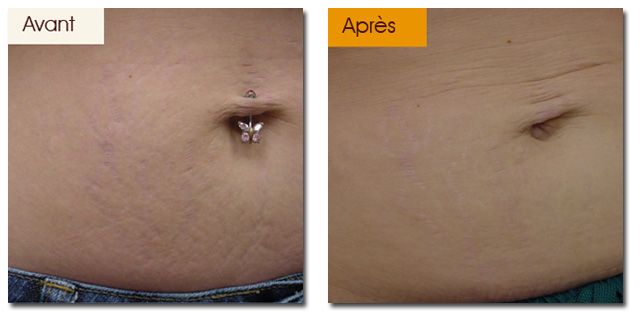 Cicatrices et Vergetures